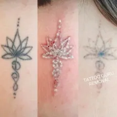 This image shows the complete tattoo removal journey for a lotus design. You can see the original tattoo, the 'frosting' effect immediately after a laser session which is normal, and the final faded result after healing.