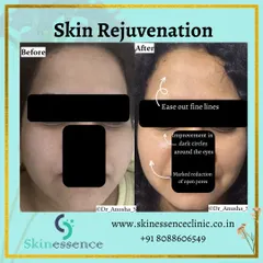 Here is a clear example of skin rejuvenation. Notice the visible reduction in open pores on the cheeks, the softening of fine lines, and the improvement in under-eye dark circles, leading to an overall smoother and refreshed appearance.