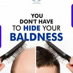 You don't have to hide your baldness. I can help you restore your natural hairline with an advanced, permanent hair transplant.