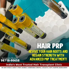 These vials contain the patient's own concentrated platelets, ready for PRP therapy. This treatment is 100% natural and uses your body's own healing power to revive hair roots and improve hair strength and density.
