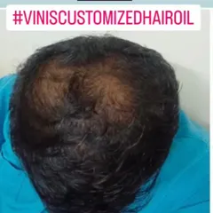 Here is another 'before' photo showing hair thinning, a concern that many men and women message me about. It can be stressful, but there are natural ways to help.