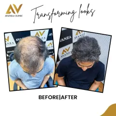 From significant thinning across the entire scalp to a full head of thick, healthy hair. This transformation showcases the power of our 'Hairodynamic' technique to achieve maximum density.