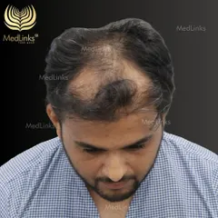 This patient was experiencing thinning across the top of his scalp. Our goal was to restore density and create a natural look. The 'before' image shows the extent of the hair loss, a common pattern we treat.