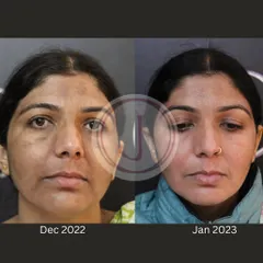 Just one month can make a difference. This image shows the initial improvement in facial pigmentation after starting a customized treatment plan during the winter, a time when skin can be prone to dullness.