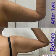 This is a one week post-procedure result for arm liposuction. The patient was concerned about "bat wings," and this treatment effectively removed the excess fat, creating a slimmer and more toned arm contour. This allows my patients to feel more confident in sleeveless clothing.