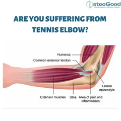 This anatomical illustration shows the tendons affected in Tennis Elbow. The condition results from overloaded tendons due to repetitive wrist and arm motions, common in sports but also in many professions.