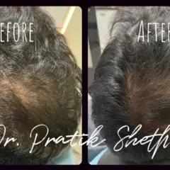 This client's transformation after GFC treatment shows a clear increase in hair volume and scalp coverage. It highlights the effectiveness of our non-surgical hair restoration options.