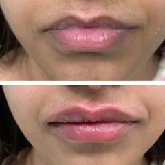 This before-and-after image shows the immediate, natural-looking result of a lip filler treatment. My approach focuses on restoring subtle volume and defining the lip shape to enhance your features, not alter them. The procedure is quick and provides a visible yet balanced enhancement.