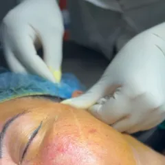 A close-up of a threadlift procedure in progress. The threads are carefully inserted beneath the skin to create a supportive mesh that lifts sagging tissue and stimulates collagen production.