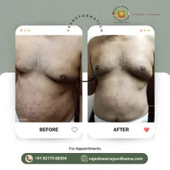 This client's torso shows a significant improvement in a chronic skin condition. My approach combines internal medicine and external applications to calm inflammation and heal the skin from within.