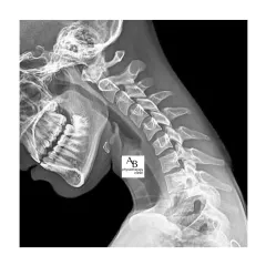 This is a real X-ray showing the effects of "Tech Neck." The constant forward head posture straightens the natural curve of the cervical spine, leading to chronic pain and degeneration.