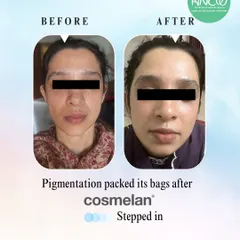 This is the power of a targeted, professional treatment plan. Our Cosmelan peel is a world-leading depigmentation method that effectively reduces stubborn melasma and hyperpigmentation, revealing a dramatically clearer and more even-toned complexion.