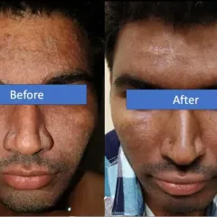 Here you can see a significant improvement in skin texture and pigmentation after a customized treatment plan. We address concerns like sun damage and post-acne marks to restore a clearer, more even complexion.