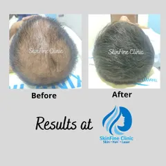 This before and after image shows the result of a 5-month treatment plan for a patient with a 3-year history of hair loss. After a thorough trichoscopic assessment and blood tests, we used a combination of micro-PRP therapy and cyclical supplements to achieve this significant hair regrowth.