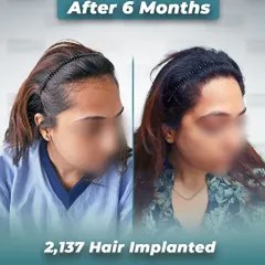 We specialize in female hair restoration, as shown in this 6 month before and after. Using our no-shave hair transplant technique, we implanted 2,137 hairs to restore her hairline and add density, achieving a beautiful and natural result without compromising her existing hair.
