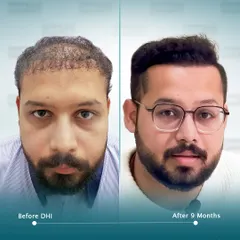A frontal before and after of the same 25-year-old correction case. Nine months after our DHI procedure, his hairline is restored, and his confidence is back. This is the DHI difference.