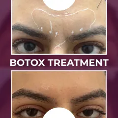 This before and after shows the precision of a Botox treatment for frown lines between the brows. The result is a smoother, more relaxed expression.
