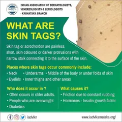 This educational graphic defines skin tags, or acrochordons, and lists common areas they appear. It also explains the typical causes and demographics, such as friction, hormones, and age.