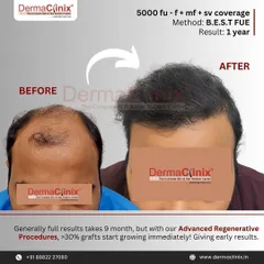 With our advanced regenerative procedures combined with B.E.S.T. FUE, we can achieve earlier results. This one year outcome with 5000 follicular units shows excellent coverage and density, with over 30% of grafts growing immediately post surgery.