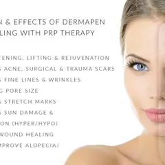 This graphic highlights the many benefits of Dermapen microneedling, a procedure I offer for skin rejuvenation. It is effective for improving acne scars, fine lines, pore size, and even sun damage by stimulating your skin's natural healing response.