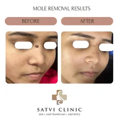 This image displays the result of a mole removal procedure from the bridge of the nose. I perform these removals with precision to be quick, comfortable, and minimize the risk of scarring, addressing both cosmetic and medical concerns.