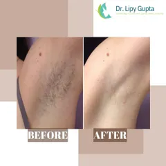 This before and after image shows the significant reduction of underarm hair after a course of laser treatments. The result is smooth, clear skin, free from the dark shadow of hair, irritation, and ingrown hairs often caused by shaving.