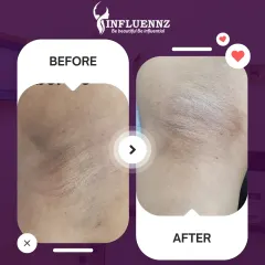 A clear before and after comparison of an underarm brightening treatment. You can see a noticeable improvement in skin tone and texture, reducing the appearance of dark patches.