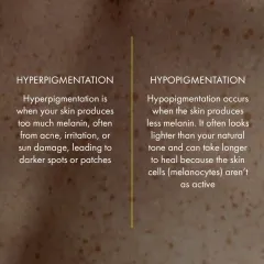 This graphic defines hyperpigmentation, caused by excess melanin from factors like sun damage, and hypopigmentation, a loss of pigment. A correct diagnosis is crucial as treatment approaches differ significantly.