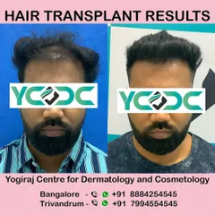 A frontal view of a successful FUE hair transplant. I meticulously design the hairline to frame the face naturally, avoiding any signs of artificiality. The result is a fuller head of hair that looks and feels like your own.