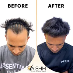 A side-by-side comparison showing a significant increase in hair density and a completely natural-looking result. We focused on creating a soft, well-defined hairline that frames the face perfectly.