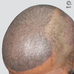 A look at the scalp just after surgery for a Grade 6 case. 5700 grafts were meticulously placed in a single session to recreate the hairline and add density from the frontal area to the crown.