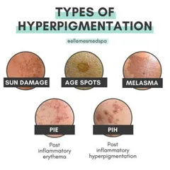 This graphic illustrates the different types of hyperpigmentation I treat, from sun damage and age spots to melasma and post-acne marks (PIE and PIH). A correct diagnosis of the type of pigmentation is essential for effective treatment.