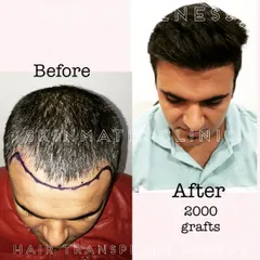 This is the final result 10 months after a 2000-graft BOOST FUE hair transplant. The client's hairline is restored, and the density creates a youthful and natural appearance.