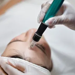 Microneedling is a powerful collagen induction therapy. I use a professional-grade device to create controlled micro-injuries, which stimulates your skin’s natural healing process to improve scars, pores, and fine lines for a revitalized appearance.