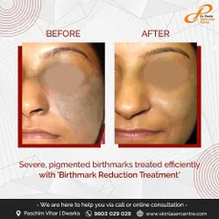 This patient was treated for a severe pigmented birthmark. Using a specialized birthmark reduction treatment, we were able to significantly lighten the area and even out the skin tone for a renewed appearance.