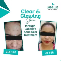 See the clear and glowing results from our tailored acne scar treatment. We focus on reducing blemishes and improving skin texture to restore your skin's natural radiance.