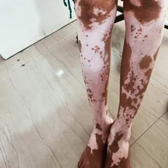 This image shows a case of Vitiligo vulgaris on the legs before treatment. Our clinic offers a range of successful treatments, including laser and UVB therapy, at an economical cost.