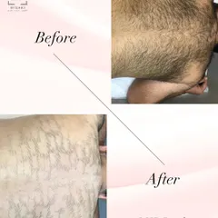 This before and after of a back hair removal treatment shows the dramatic difference my service can make. We achieved a smooth, hair-free result for a boost in confidence.