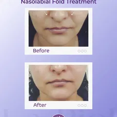 This image demonstrates the result of a Nasolabial Fold Treatment. By carefully restoring volume to the area around the nose and mouth, we can soften smile lines and create a smoother, more balanced facial appearance without looking "done."