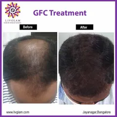 This client experienced significant hair regrowth and thickening after undergoing GFC treatment for male pattern baldness. The 'after' image shows a dramatic improvement in density across the scalp.
