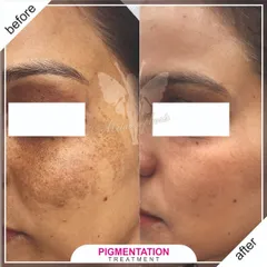 Stubborn pigmentation and sun damage don't stand a chance. Here you can see a significant clearing of hyperpigmentation, revealing a brighter and more even skin tone using a tailored plan of peels and laser sessions.