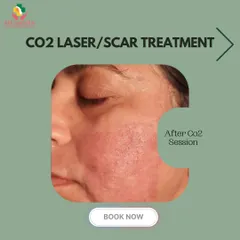 Immediately after a CO2 laser session, the skin shows redness, which is a normal part of the healing process. This indicates that the treatment is stimulating collagen production and beginning the skin renewal cycle.