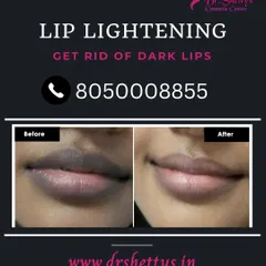 This before and after image shows the significant results of our laser lip lightening treatment. We can effectively reduce dark pigmentation, giving you lighter, more evenly toned lips with a safe and permanent procedure.