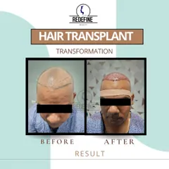 A side-by-side look at a hair transplant transformation. The 'before' shows the initial consultation with the hairline marked for the procedure, and the 'after' shows the result right after the grafts have been implanted, setting the foundation for future growth.
