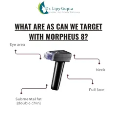 We can target multiple areas with Morpheus8. It is highly effective for tightening skin around the eye area, the full face, the neck, and even reducing submental fat under the chin.