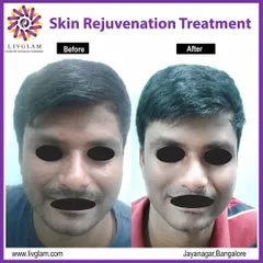 This male client underwent a skin rejuvenation treatment to address dullness and uneven texture. The 'after' photo reveals a brighter complexion and smoother skin, demonstrating a refreshed and more youthful appearance.