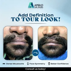 We specialize in moustache transplants that enhance facial symmetry. This client received a fuller, well defined moustache, which balanced their features and provided a significant boost in confidence.
