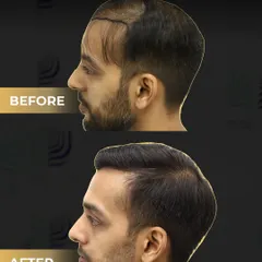 A side profile view of the same corrective case. We meticulously redesigned the hairline and added density to create a seamless and natural flow, erasing any signs of the previous bad transplant.