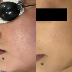 This client's concern was open pores and uneven skin texture. This split image shows the visible refinement in skin texture and pore size after a targeted laser treatment, resulting in a smoother surface.