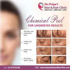 These before-and-after images show the results of chemical peels for the undereye area. The treatment effectively reduces wrinkles, expression lines, under-eye circles, bags, and drooping of the upper eyelid.